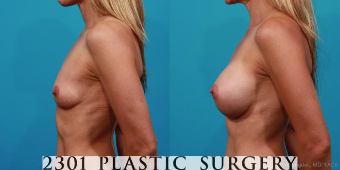 Before & After Breast Augmentation Case 239 View #2 View in Fort Worth, Plano, & Frisco, Texas