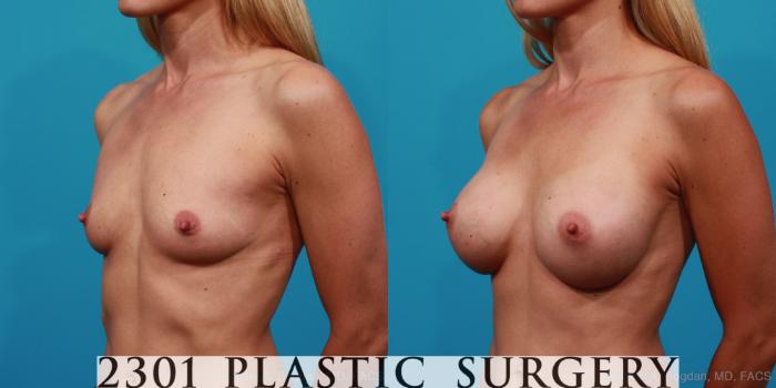 Before & After Breast Augmentation Case 239 View #3 View in Fort Worth, Plano, & Frisco, Texas