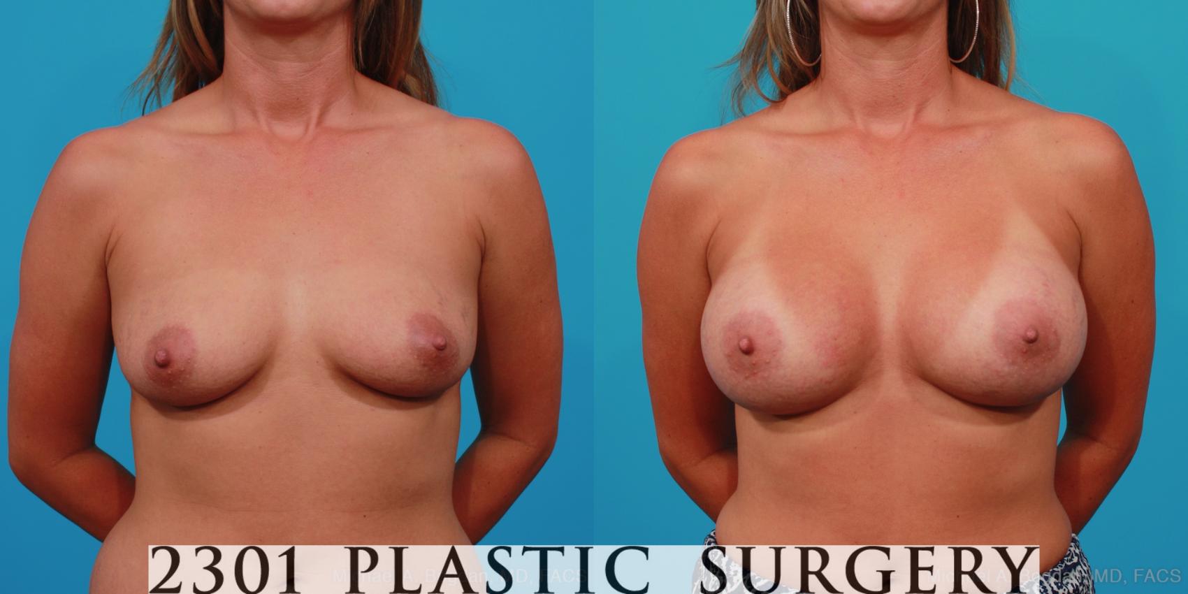 Before & After Breast Augmentation Case 242 View #1 View in Fort Worth, Plano, & Frisco, Texas