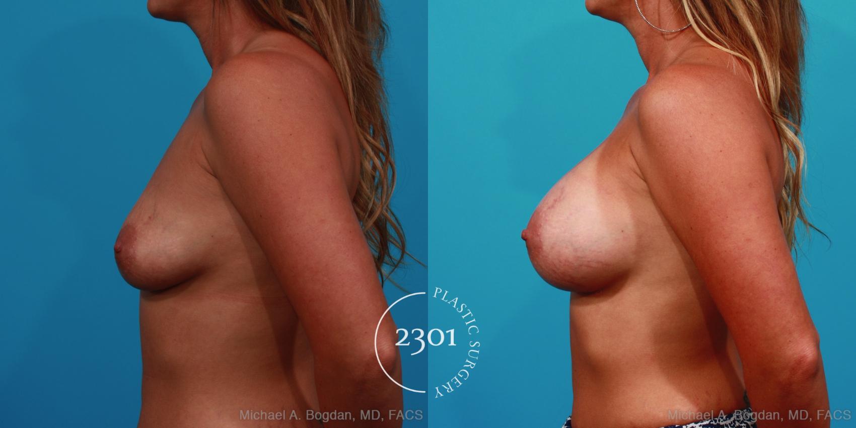 Before & After Silicone Implants Case 242 View #2 View in Fort Worth, Plano, & Frisco, Texas