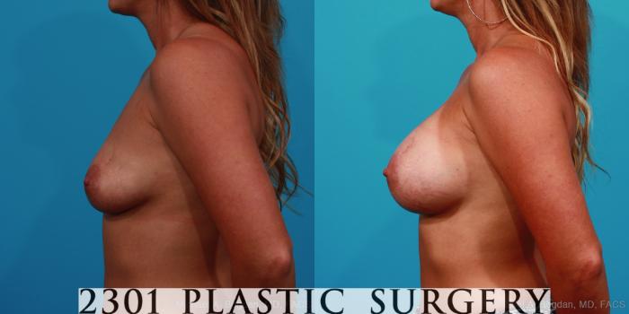 Before & After Breast Augmentation Case 242 View #2 View in Fort Worth, Plano, & Frisco, Texas