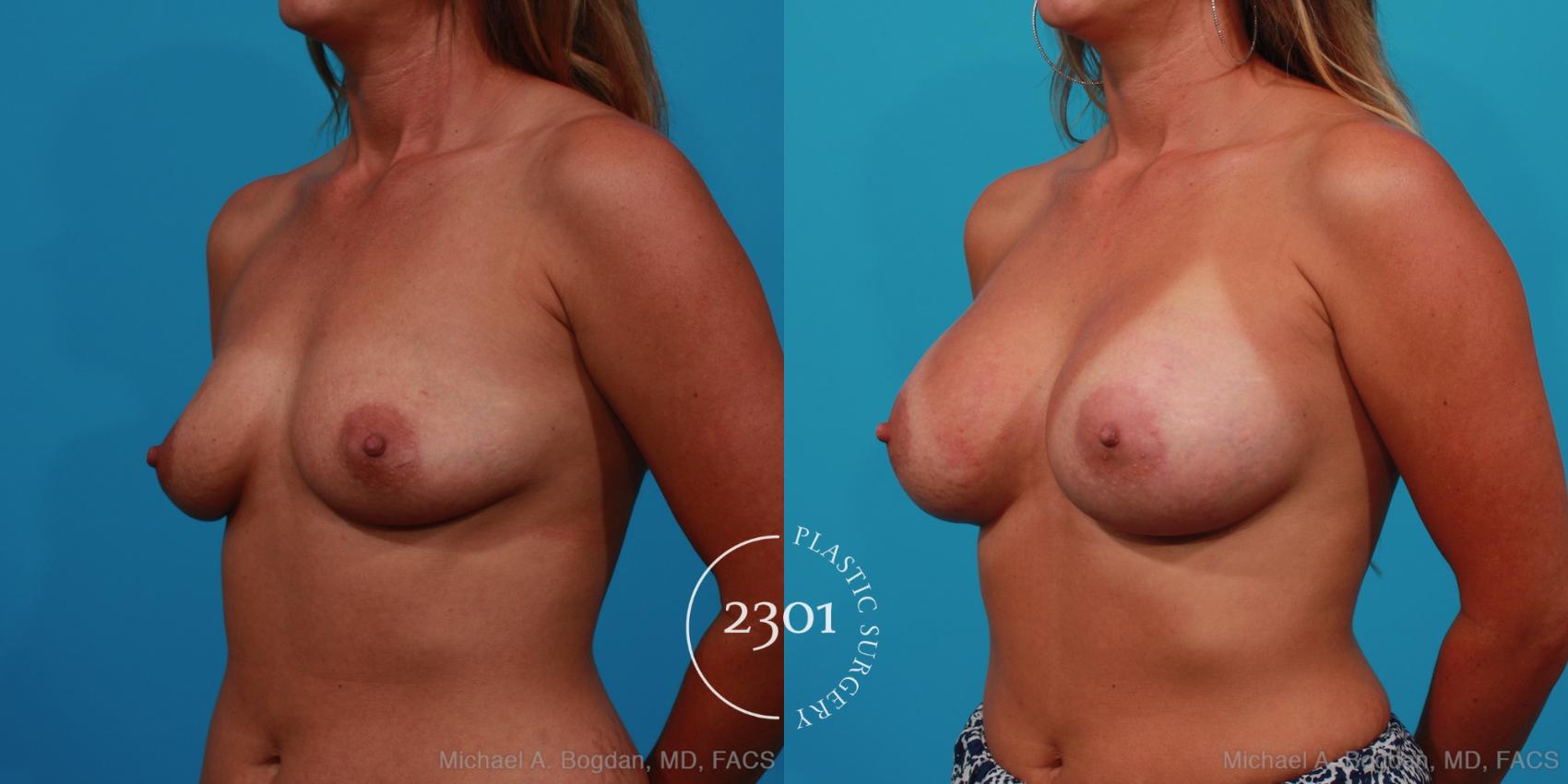 Before & After Silicone Implants Case 242 View #3 View in Fort Worth, Plano, & Frisco, Texas