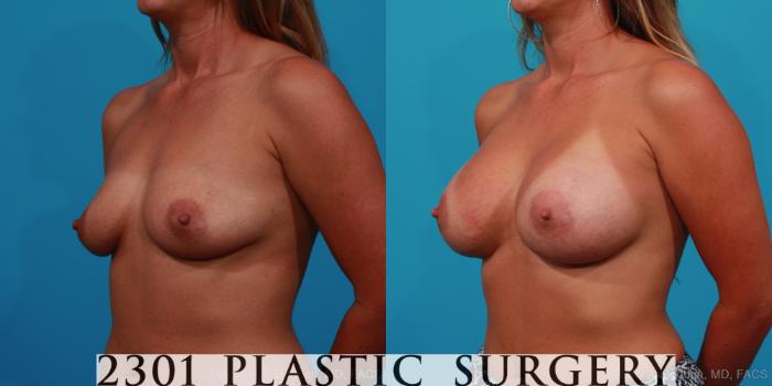 Before & After Breast Augmentation Case 242 View #3 View in Fort Worth, Plano, & Frisco, Texas