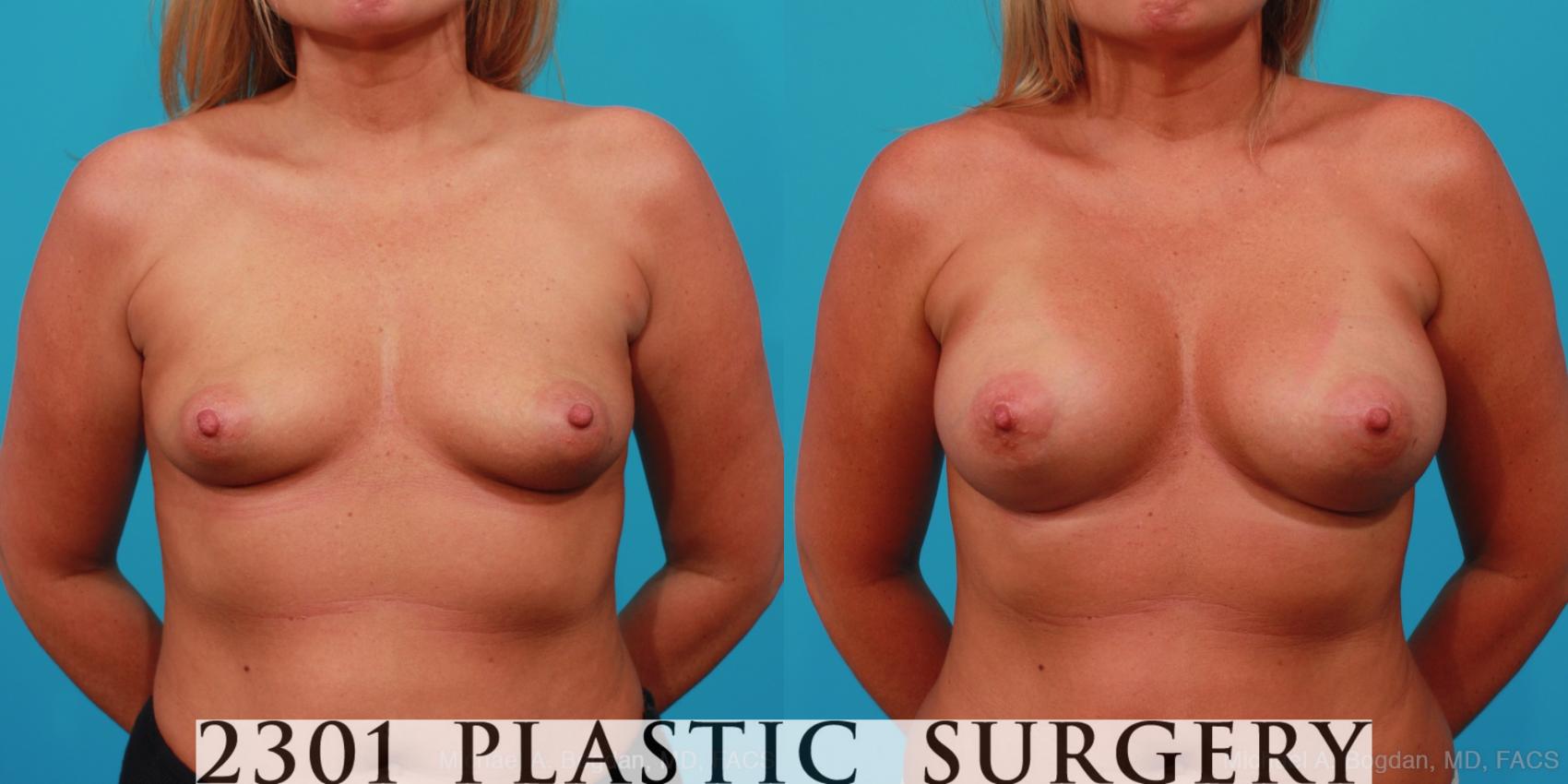 Before & After Silicone Implants Case 243 View #1 View in Fort Worth, Plano, & Frisco, Texas