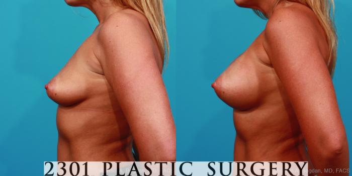 Before & After Breast Augmentation Case 243 View #2 View in Fort Worth, Plano, & Frisco, Texas