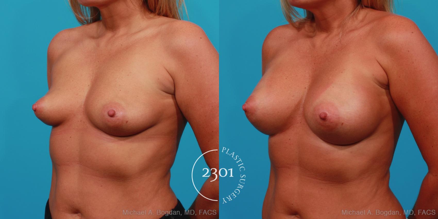 Before & After Silicone Implants Case 243 View #3 View in Fort Worth, Plano, & Frisco, Texas