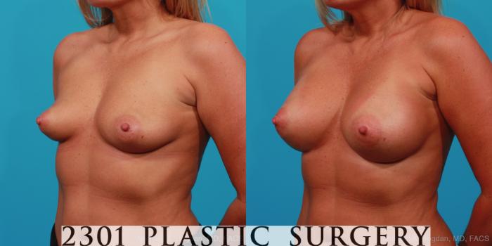 Before & After Silicone Implants Case 243 View #3 View in Fort Worth, Plano, & Frisco, Texas