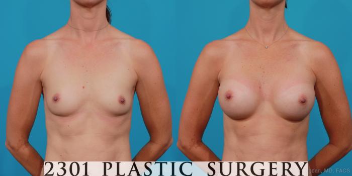 Before & After Silicone Implants Case 244 View #1 View in Fort Worth, Plano, & Frisco, Texas