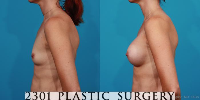 Before & After Silicone Implants Case 244 View #2 View in Fort Worth, Plano, & Frisco, Texas