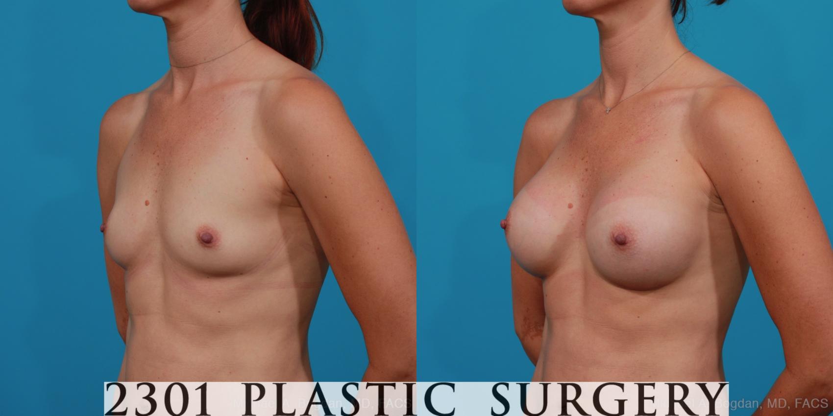 Before & After Silicone Implants Case 244 View #3 View in Fort Worth & Frisco, Texas
