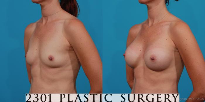 Before & After Breast Augmentation Case 244 View #3 View in Fort Worth, Plano, & Frisco, Texas