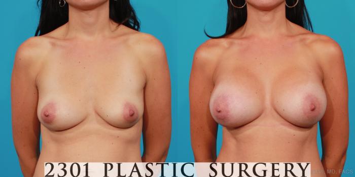 Before & After Silicone Implants Case 247 View #1 View in Fort Worth, Plano, & Frisco, Texas