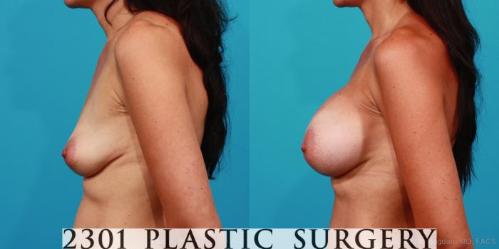 Before & After Silicone Implants Case 247 View #2 View in Fort Worth, Plano, & Frisco, Texas
