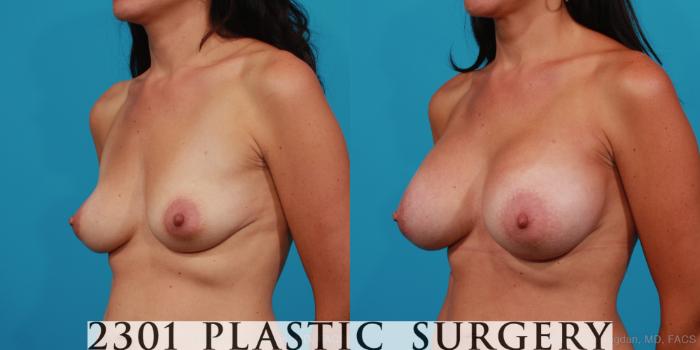 Before & After Silicone Implants Case 247 View #3 View in Fort Worth, Plano, & Frisco, Texas