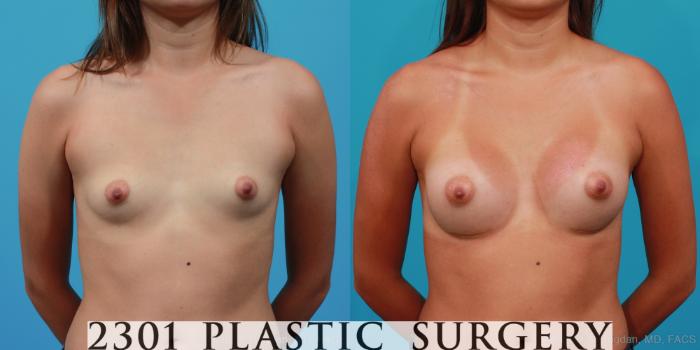 Before & After Silicone Implants Case 249 View #1 View in Fort Worth, Plano, & Frisco, Texas