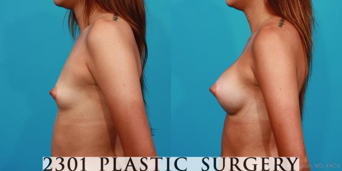 Before & After Silicone Implants Case 249 View #2 View in Fort Worth, Plano, & Frisco, Texas