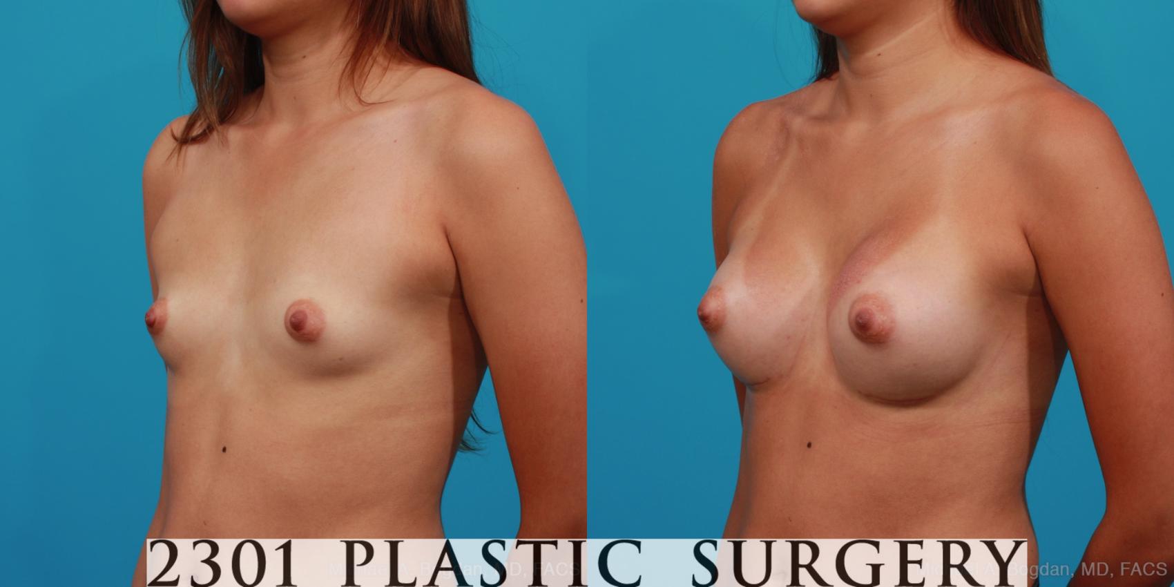 Before & After Silicone Implants Case 249 View #3 View in Fort Worth & Frisco, Texas