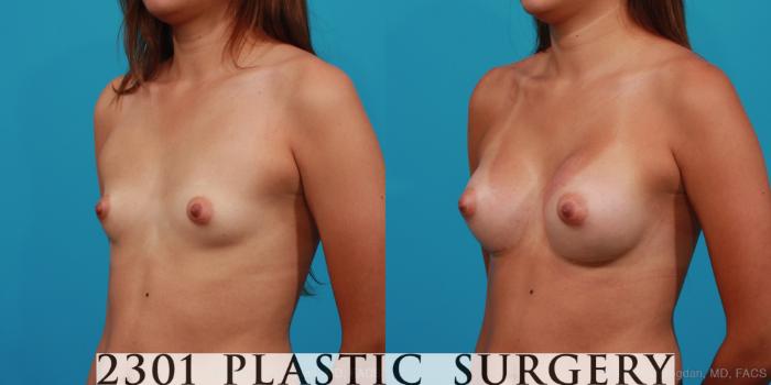 Before & After Silicone Implants Case 249 View #3 View in Fort Worth, Plano, & Frisco, Texas
