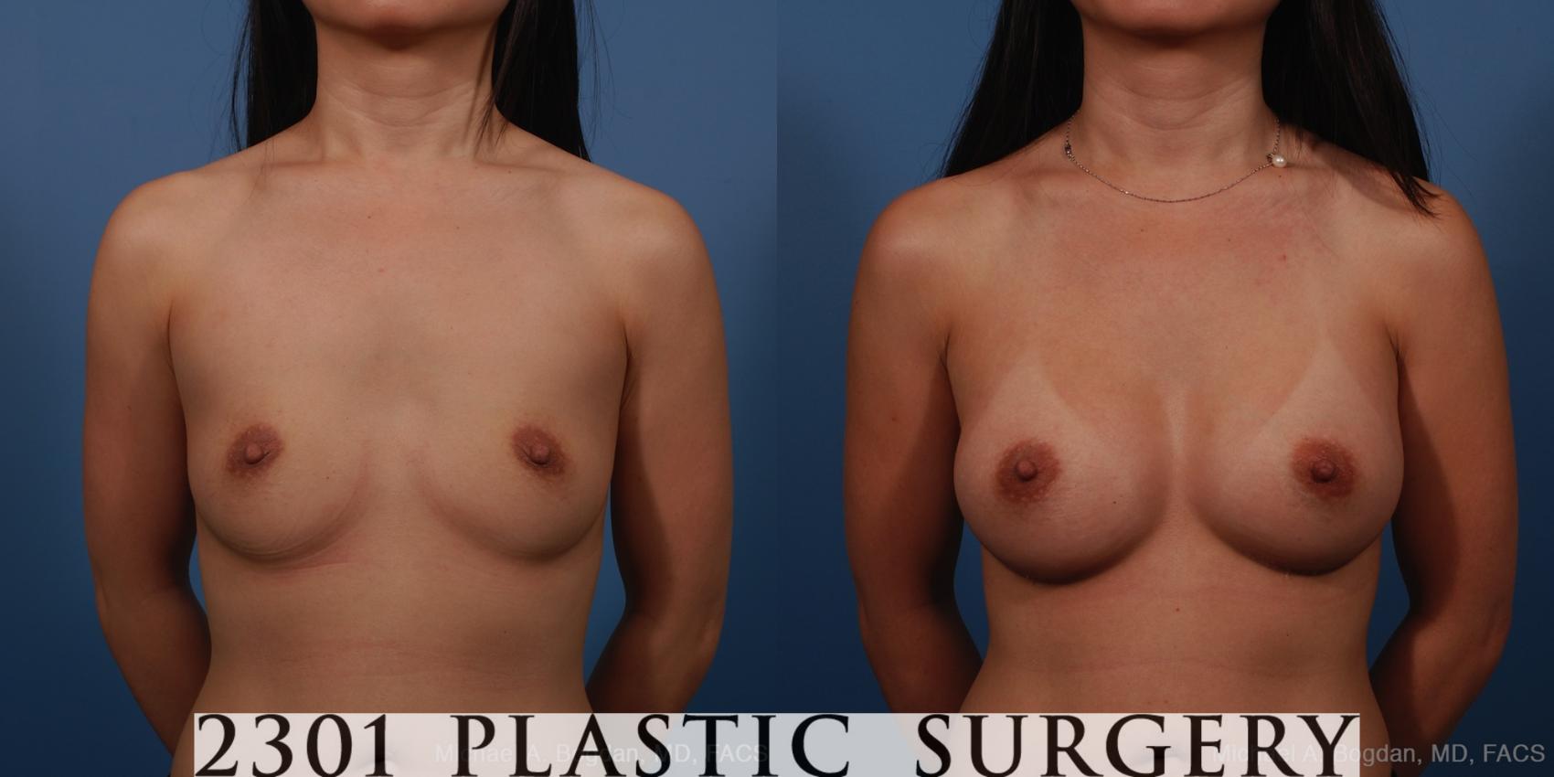 Before & After Silicone Implants Case 250 View #1 View in Fort Worth, Plano, & Frisco, Texas