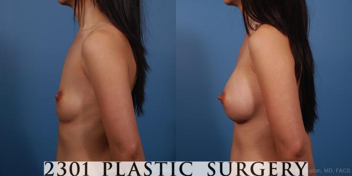 Before & After Silicone Implants Case 250 View #2 View in Fort Worth, Plano, & Frisco, Texas