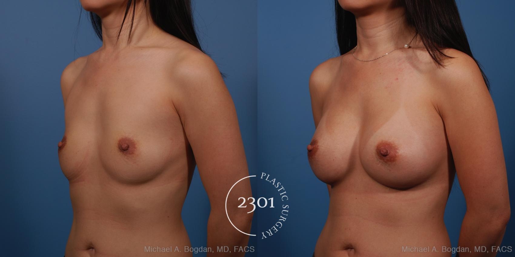 Before & After Silicone Implants Case 250 View #3 View in Fort Worth, Plano, & Frisco, Texas