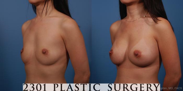 Before & After Silicone Implants Case 250 View #3 View in Fort Worth, Plano, & Frisco, Texas