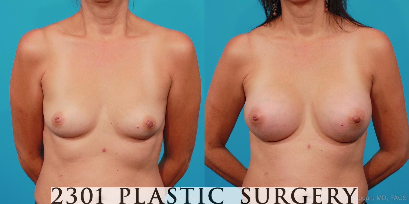 Before & After Breast Augmentation Case 254 View #1 View in Fort Worth, Plano, & Frisco, Texas