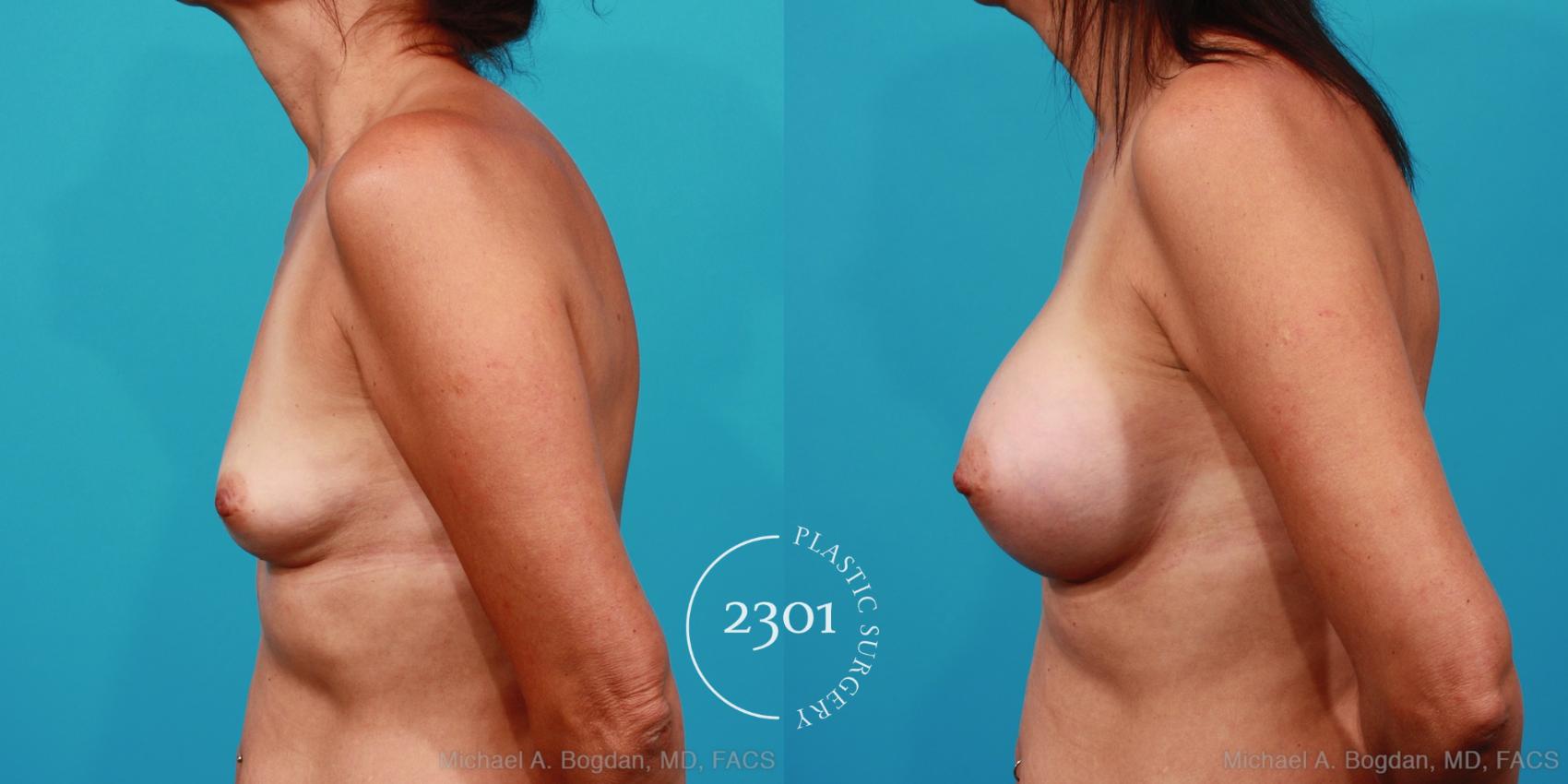 Before & After Silicone Implants Case 254 View #2 View in Fort Worth, Plano, & Frisco, Texas