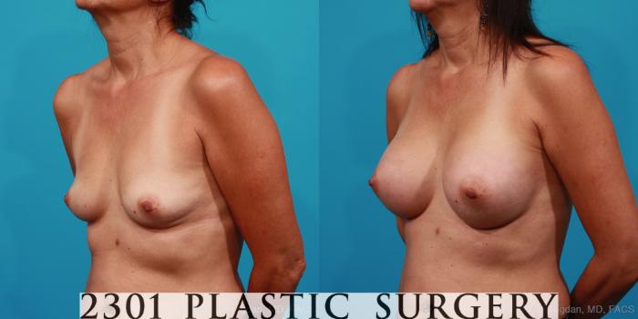 Before & After Silicone Implants Case 254 View #3 View in Fort Worth, Plano, & Frisco, Texas