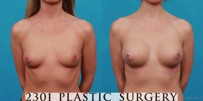 Before & After Silicone Implants Case 256 View #1 View in Fort Worth, Plano, & Frisco, Texas
