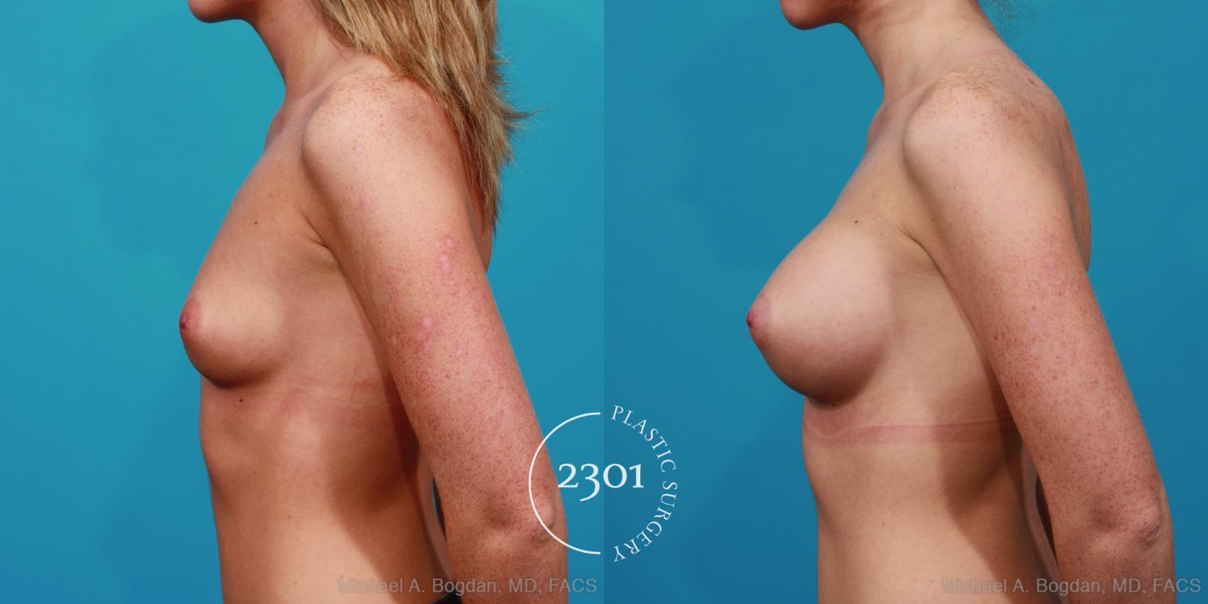 Before & After Silicone Implants Case 256 View #2 View in Fort Worth, Plano, & Frisco, Texas