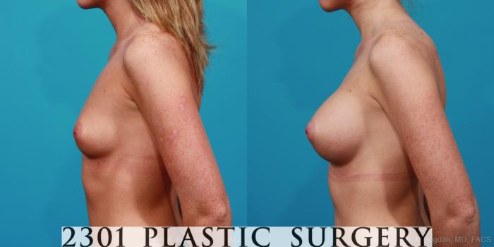 Before & After Silicone Implants Case 256 View #2 View in Fort Worth, Plano, & Frisco, Texas