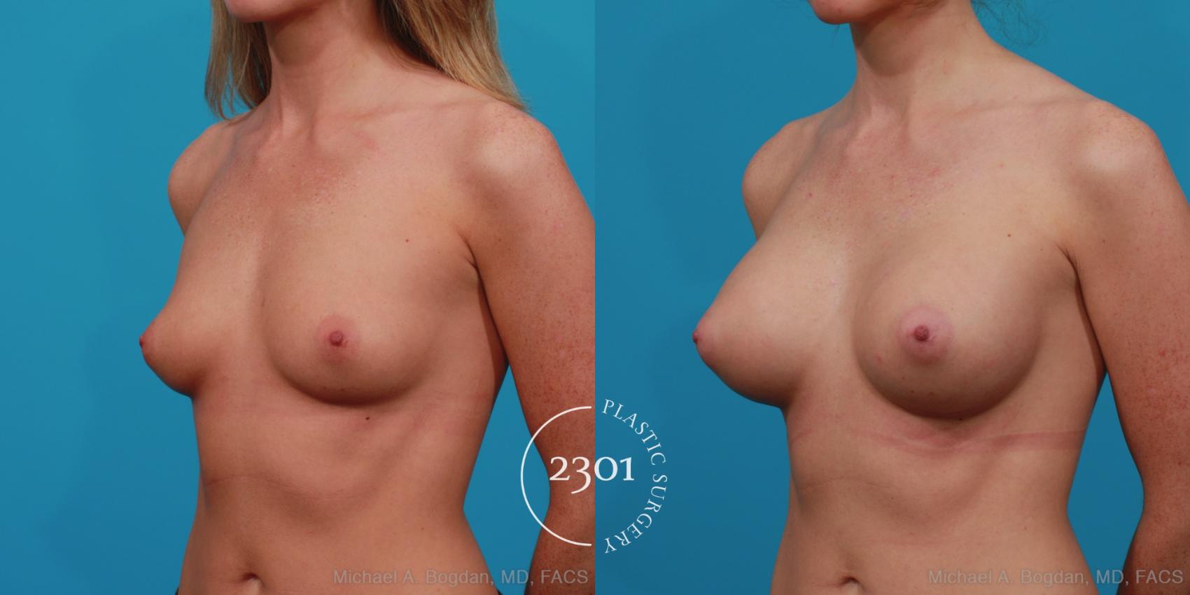 Before & After Silicone Implants Case 256 View #3 View in Fort Worth, Plano, & Frisco, Texas