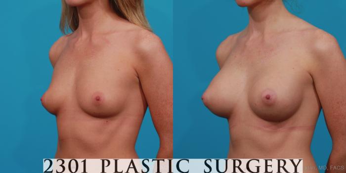 Before & After Silicone Implants Case 256 View #3 View in Fort Worth, Plano, & Frisco, Texas