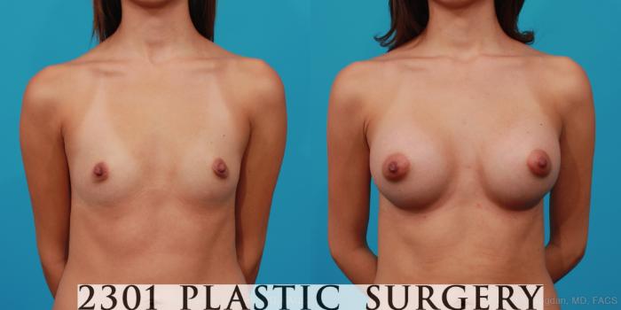 Before & After Breast Augmentation Case 258 View #1 View in Fort Worth, Plano, & Frisco, Texas