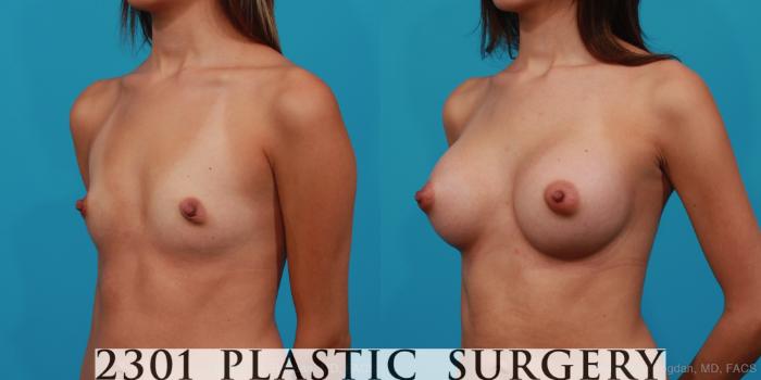 Before & After Breast Augmentation Case 258 View #3 View in Fort Worth, Plano, & Frisco, Texas