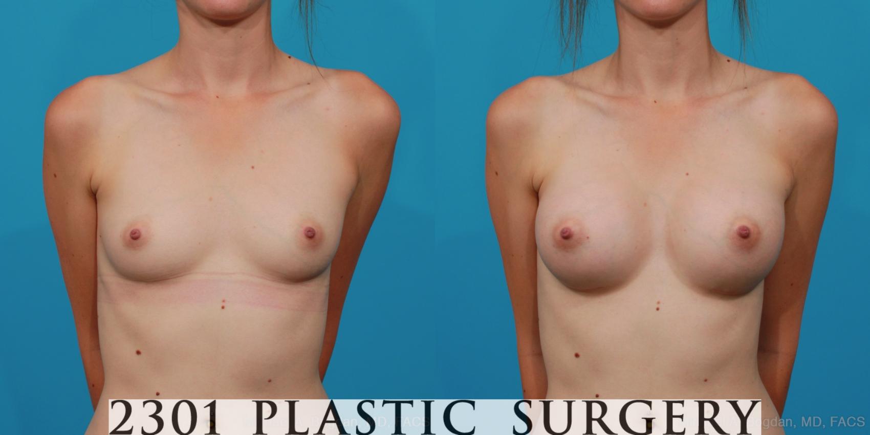 Before & After Silicone Implants Case 262 View #1 View in Fort Worth & Frisco, Texas