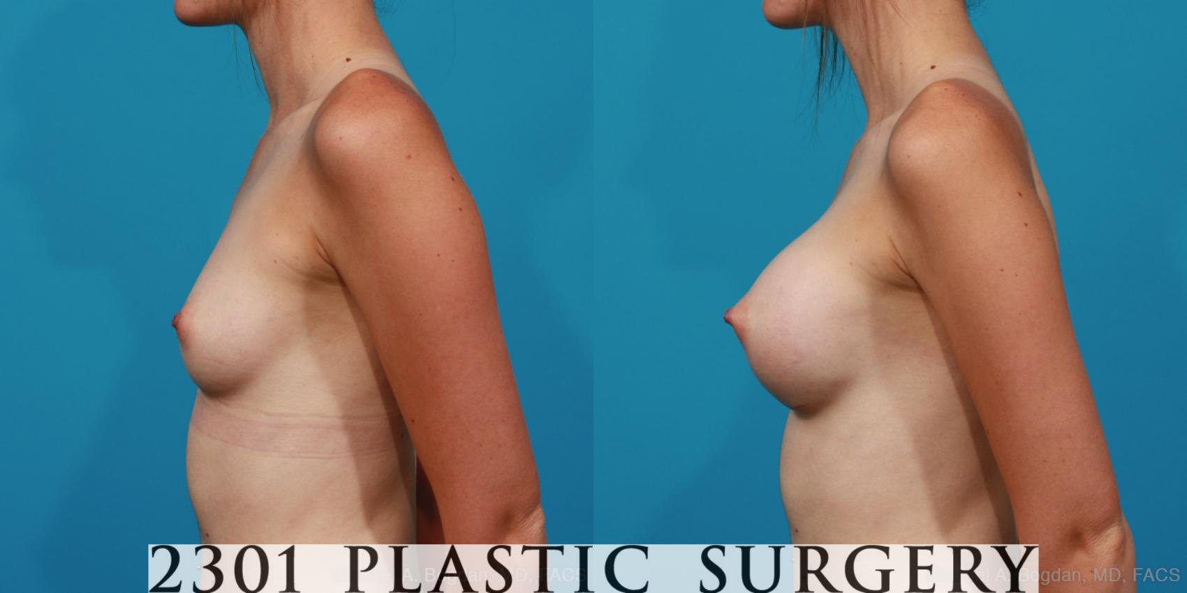 Before & After Silicone Implants Case 262 View #2 View in Fort Worth & Frisco, Texas