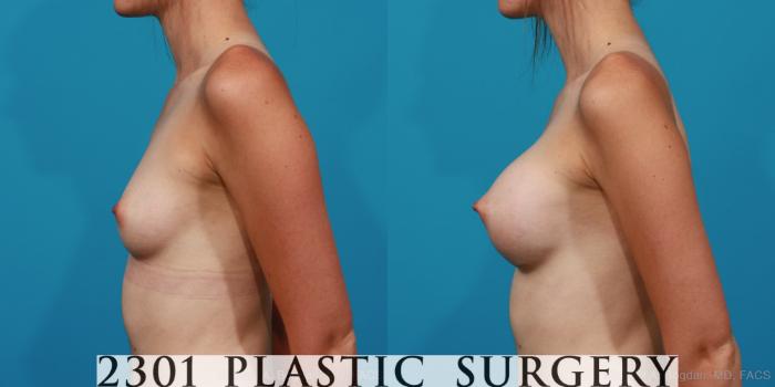 Before & After Silicone Implants Case 262 View #2 View in Fort Worth, Plano, & Frisco, Texas