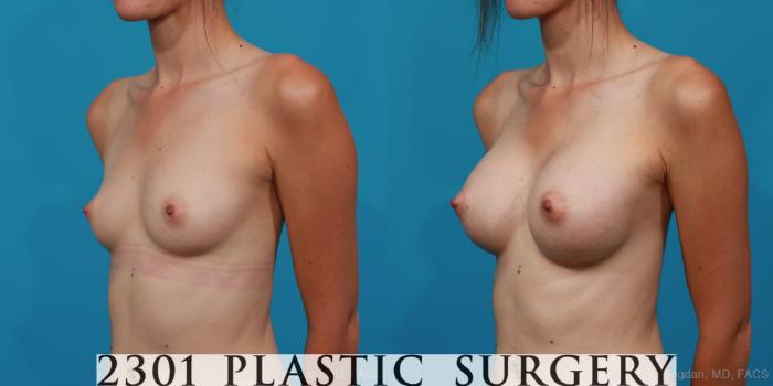 Before & After Breast Augmentation Case 262 View #3 View in Fort Worth, Plano, & Frisco, Texas
