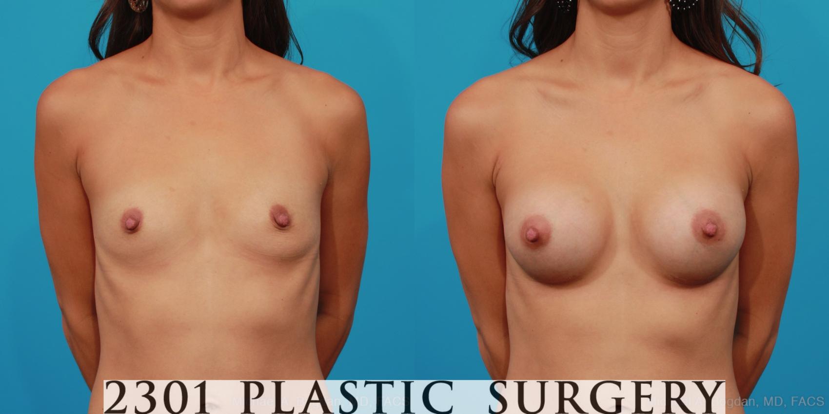 Before & After Silicone Implants Case 264 View #1 View in Fort Worth, Plano, & Frisco, Texas