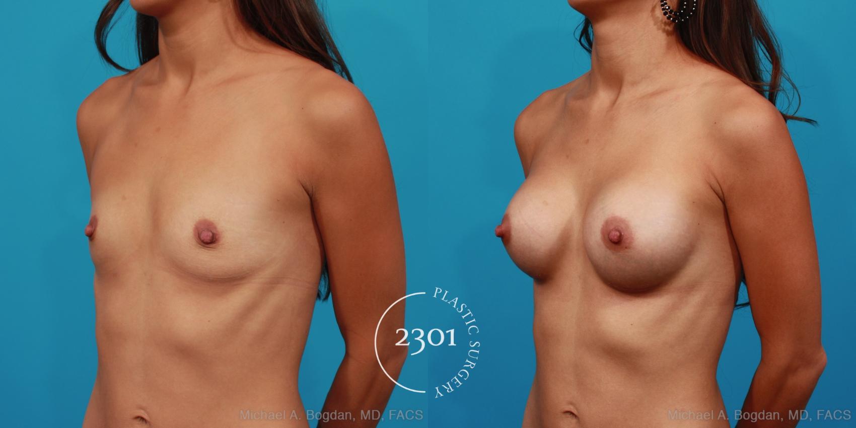 Before & After Silicone Implants Case 264 View #3 View in Fort Worth, Plano, & Frisco, Texas