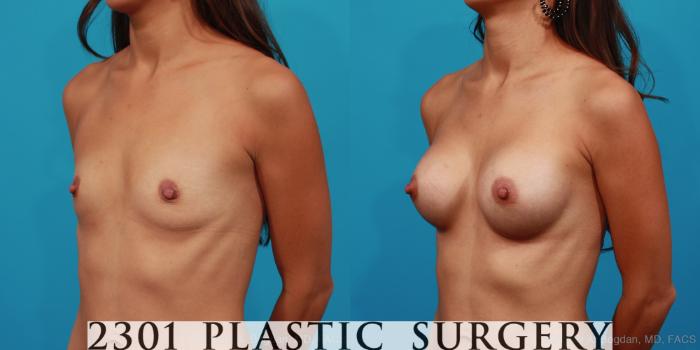 Before & After Silicone Implants Case 264 View #3 View in Fort Worth, Plano, & Frisco, Texas