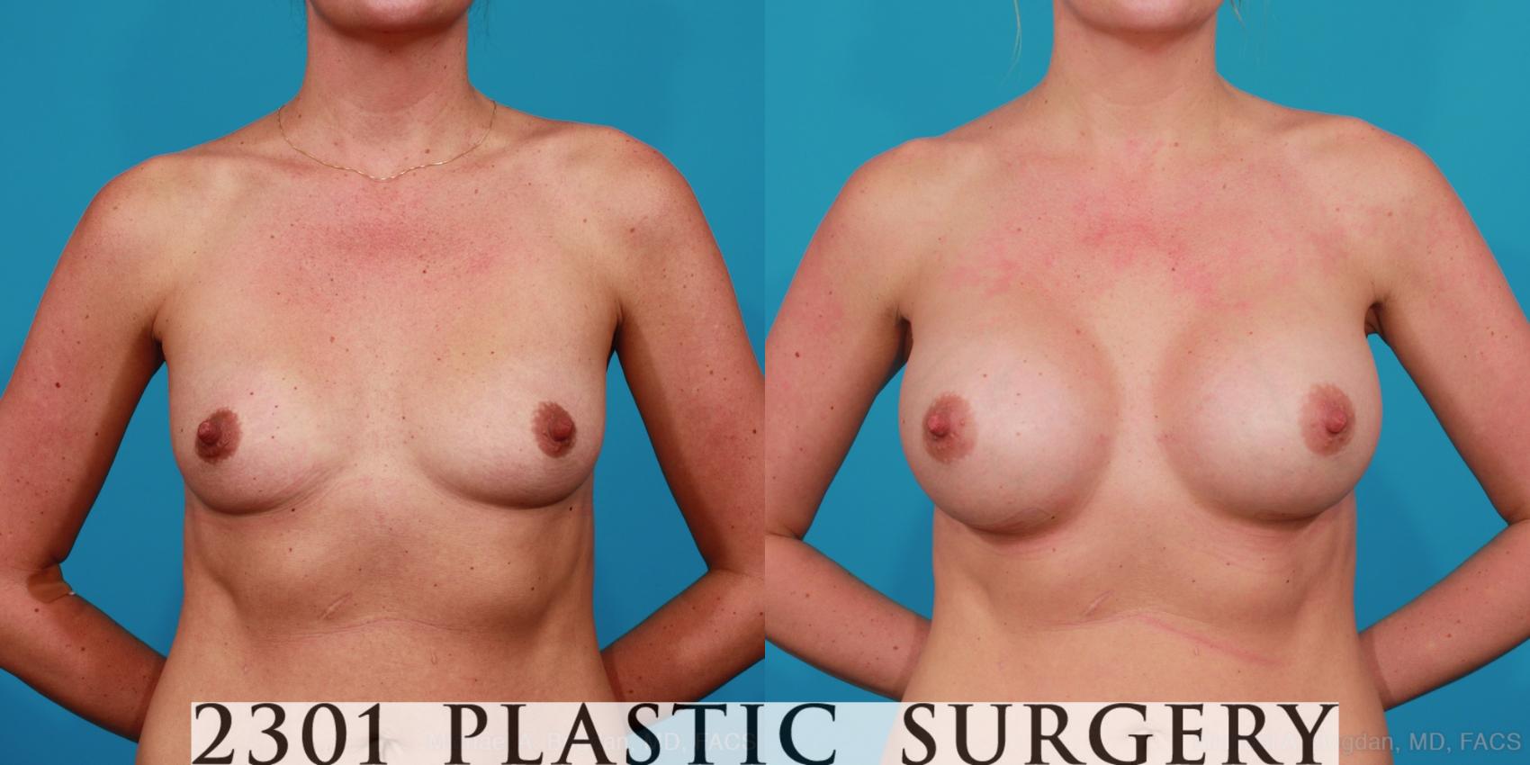 Before & After Silicone Implants Case 271 View #1 View in Fort Worth, Plano, & Frisco, Texas