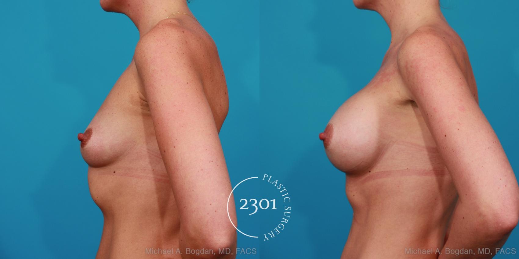 Before & After Silicone Implants Case 271 View #2 View in Fort Worth, Plano, & Frisco, Texas