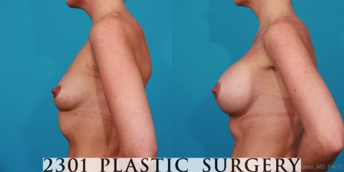 Before & After Silicone Implants Case 271 View #2 View in Fort Worth, Plano, & Frisco, Texas