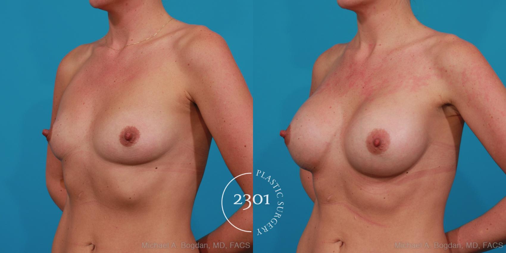 Before & After Silicone Implants Case 271 View #4 View in Fort Worth, Plano, & Frisco, Texas