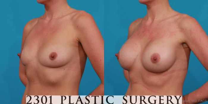 Before & After Silicone Implants Case 271 View #4 View in Fort Worth, Plano, & Frisco, Texas
