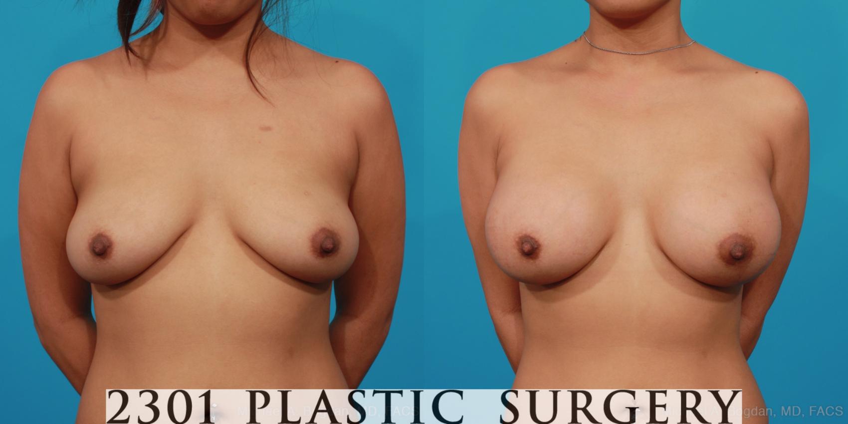 Before & After Breast Augmentation Case 277 View #1 View in Fort Worth, Plano, & Frisco, Texas
