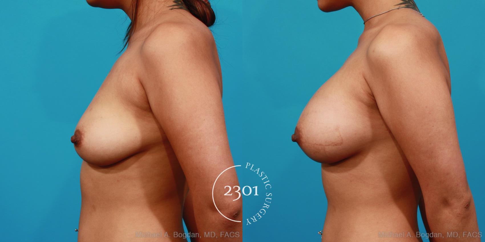 Before & After Silicone Implants Case 277 View #2 View in Fort Worth, Plano, & Frisco, Texas